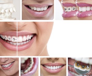 dental braces