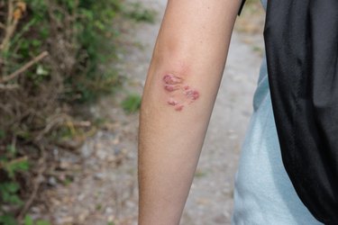 Arm of a woman with a skin rash on her elbows taking a walk in the countryside as therapy for stress